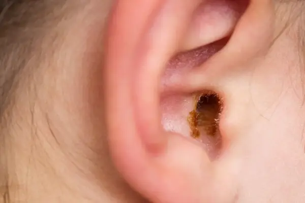 earwax build-ip